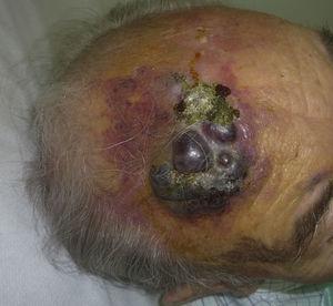 Placa rojizo-violácea con áreas nodulares en la frente de un varón anciano.