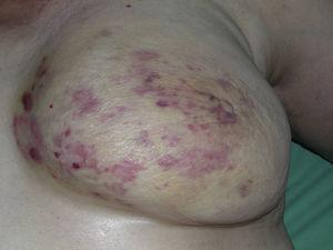 Múltiples máculas y manchas eritematosas, con algunas pápulas rojizas sobre una piel amarillenta asientan en una mama irradiada previamente por cáncer.