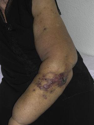 Pápulas y nódulos rojizo-violáceos, con áreas de aspecto contusiforme en un brazo con linfedema secundario a cirugía por cáncer de mama.