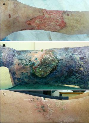 Evolución de la úlcera situada en la extremidad inferior del caso 1 en la que se aisló repetidamente Fusarium sp. y Pseudomonas aeruginosa. Las imágenes corresponden a las fechas de: octubre de 2012 (A), enero de 2013 (B) y abril de 2013 (C).