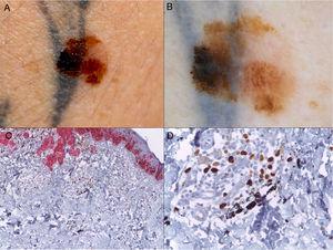 A) Melanoma en el miembro superior derecho sobre tatuaje reciente. B) Imagen dermatoscópica que muestra una llamativa asimetría de colores y estructuras, destacando la presencia de retículo atípico, pseudópodos y puntos y glóbulos de distribución irregular. C) Imagen histológica con técnica de inmunohistoquímica para HMB45-Ki67 en la que se observa la presencia de nidos de células neoplásicas en dermis (rojo), así como gránulos negros de pigmento de tatuaje en el interior de macrófagos y libres en dermis (HMB45-Ki67, ×4). D) Detalle de los gránulos negros de pigmento del tatuaje (HMB45-Ki67, ×40).