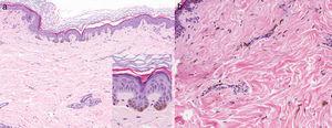 a. Biopsia de la muñeca que evidencia hiperplasia epidérmica lentiginosa con proyecciones bulbosas hiperpigmentadas de las crestas epidérmicas e incremento de los melanocitos basales (hematoxilina-eosina, ×10, y detalle en recuadro, ×40). b. Biopsia de la espalda con melanocitos dendríticos en la dermis papilar y reticular e hiperpigmentación de la capa basal epidérmica (hematoxilina-eosina, ×20).