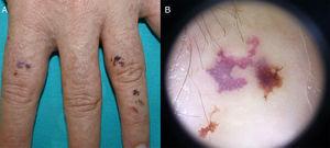 A. Pápulas y vesículas hemorrágicas en dorso de los dedos (caso 2). B. Dermatoscopia de una lesión, donde se evidencian signos de hemorragia.