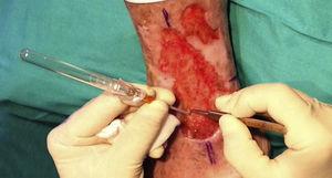 Método de inserción de las biopsias punch en el seno de las úlceras.