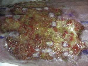 Persistencia de los tallos pilosos en el lecho de la úlcera semanas después del trasplante.