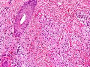 Síndrome de Blau. Granulomas no caseificantes con histiocitos, linfocitos, eosinófilos y células gigantes multinucleadas (H/E ×20).