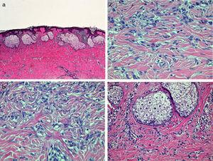a) En la dermis, proliferación mal delimitada de células fusiformes con nidos de células sebáceas en su zona superior (hematoxilina-eosina×40). b) A mayor detalle, proliferación dérmica constituida por células fusiformes con un patrón arremolinado (hematoxilina-eosina×200). c) Periferia de lesión, atrapamiento de fibras de colágeno entre células fibroblásticas (hematoxilina-eosina×200). d) A mayor detalle, nidos de células sebáceas (hematoxilina-eosina×100).