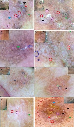 Clinical and dermoscopic images of PAK. A: the rhomboidal pattern with the dermoscopic horn (black arrow), the gray halo around the yellowish central keratin (blue arrow), the rosette sign (violet circle), the double white clods (red circle), grayish area and scales (red arrow). B: the rhomboidal pattern with the presence of white circles (black arrow), the gray halo around the yellowish central keratin (green arrow), the rosette sign (violet circle), the double white clods (red circle). C: the annular granular pattern with the dermoscopic horn (blue arrow), globules (green arrow), the rosette sign (violet circle). D: the rhomboidal pattern, the gray halo around the yellowish central keratin (blue arrow), the double white clods (red circle), the white circle (blue circle). E and F: the superficial pigmentation with the jelly sign with white globules (arrows), the rosette sign (circles). G: the star like appearance with the presence of white globules (green arrow), the rosette sign (violet circle) and the double white clods (red circle). H: the star like appearance with the presence of central crusts with peripheral white globules (green arrow), the rosette sign (violet circle), the double white clods (red circle), white circle around the follicular opening (black arrow) and the dermoscopic horn (red arrow).