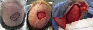 a) Lesión objeto de exéresis (epitelioma basocelular); b) Diseño del colgajo en hacha bilateral, y c) Disección del colgajo a nivel subgaleal.
