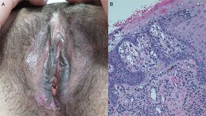 A) Úlceras bilaterales en introito y labios menores. B) Epidermis con ulceración focal, focos de paraqueratosis y marcado daño vacuolar de la basal, con queratinocitos necróticos e infiltrado inflamatorio crónico en dermis superficial (hematoxilina-eosina, ×200).