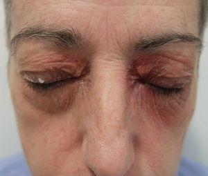Dermatitis de contacto por sombra de ojos (patrón de contorno).