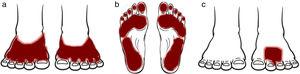 Patrones clínicos de dermatitis de contacto alérgica en los pies. a) Patrón de calzado; b) patrón plantar; y c) patrón localizado.