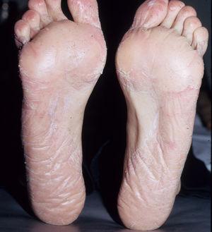 Dermatitis de contacto alérgica con patrón plantar. Nótese la no afectación del arco plantar.
