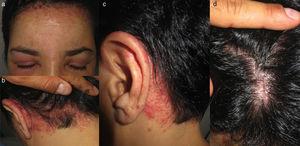 a)-d) Dermatitis de contacto alérgica por parafenilendiamina en tinte negro —a) afectación de la región frontal y los párpados; b) y c) afectación retroauricular y de la nuca; y d) escasa afectación del cuero cabelludo—.