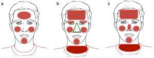 Patrones clínicos de dermatitis de contacto alérgica en la cara. a) Patrón bilateral parcheado; b) patrón aerotransportado; y c) patrón fotoalérgico.