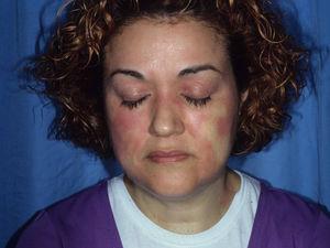 Dermatitis de contacto alérgica aerotransportada. Nótese la afectación de los párpados, los pliegues nasogenianos y en menor medida el cuello y la no afectación de la punta de la nariz (signo del pico).