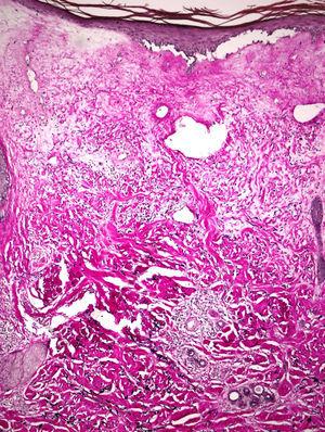Histopatología (fibras elásticas ×100): epidermis atrófica, colágeno de aspecto hialinizado y un infiltrado linfocitario en banda. Dermis reticular engrosada con haces de colágeno gruesos y compactos.