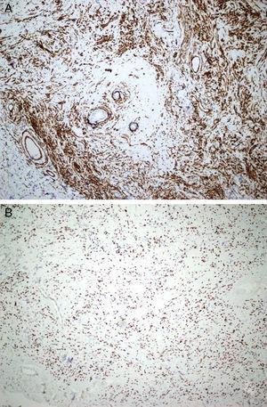 A. Tinción inmunohistoquímica difusa de las células tumorales para CD 34 (CD 34×200). B. Los núcleos expresan Stat 6 (Stat 6×200).