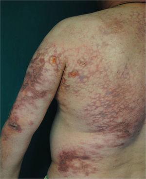 Lesiones úlcero-costrosas y poliquilodérmicas del caso 1.
