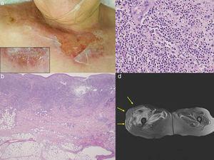 (a) Painful, erosive lesions on the upper chest with peripheral tense blisters (insert). (b) Histological features showing dense neutrophil infiltration throughout the edematous dermis. (c) Higher magnification showed neutrophil infiltration. (d) MRI examination revealed edematous swelling on the right gluteus maximus muscle.
