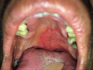 Úlcera redondeada, de bordes definidos y fondo granulomatoso, de 2cm de diámetro ubicada en paladar blando.