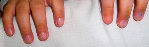 Paciente 2. Obsérvese el compromiso de la uña correspondiente al dedo índice izquierdo únicamente, presentando microniquia del lado cubital y radial del lecho ungueal. El resto de las uñas no presentan alteraciones.