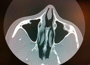 TAC: se observa perforación del septo nasal sin otras alteraciones.