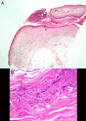 A) Trayecto sinusal relleno por material hiperqueratósico, con una pústula en superficie (H&E ×20). B) Tinción de PAS: estructuras micóticas en forma de esporas e hifas ramificadas, en ángulos de 45°.