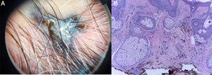 A) Dermatoscopia con patrón azul homogéneo, con estrías blancas brillantes. B) Fibrosis y proliferación de células névicas con marcada pigmentación melánica intracitoplasmática y melanófagos en dermis, sin signos de malignidad.