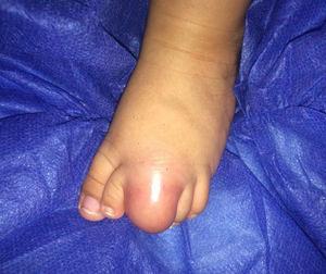 Masa de consistencia blanda de color eritematoso localizada en el tercer dedo del pie derecho.