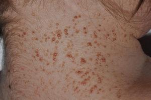 Múltiples carcinomas basocelulares en paciente con síndrome de Gorlin. Cortesía de la Dra. Á. Hernández Martín.