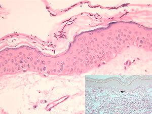 Epidermis con abundantes hifas y esporas en la capa córnea, y aplanamiento de las crestas interpapilares (PAS ×200). En detalle, disminución de fibras elásticas finas en dermis papilar (flecha) y fragmentadas en la dermis reticular superficial, así como ectasia vascular (Orceína ×100).