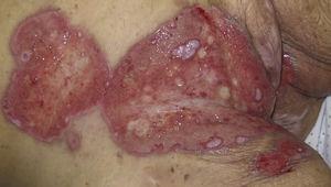 Caso 1. Se observan amplias úlceras, de fondo fibrinoso, con exudación y borde eritematoso localizadas en la región vulvar, inguinal e hipogastrio.