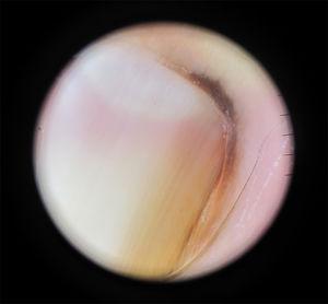 Dermatoscopia: patrón de bandas paralelas regulares, café claro, con pigmentacón del pliegue proximal y lateral (SH).