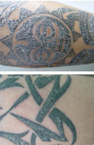 Reacción cutánea «atípica» en dos pacientes tatuados con un lote de tinta contaminada por Pseudomona aeruginosa.
