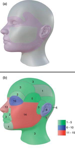 (a) Model for H zones of the face. (b) Model of distribution for all tumors in head and neck in our study. In green: areas with tumor density of 1–5. In blue: areas with tumor density of 6–10. In red: areas with tumor density of 11–15.