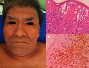 LLCTA crónica. (a) Varón de 66 años de edad con eritroderma y xerosis severa de 3 años de evolución. (b) Epidermotropismo y microabscesos de Pautriers. Tinción con hematoxilina y eosina, ×40. (c) Inmunohistoquímica CD3+, ×40. El paciente falleció 8 meses después de empezar un tratamiento con quimioterapia con gemcitabina (1.000mg/m2 cada día) y oxaliplatino (100mg/m2 cada día) cada 3 semanas.