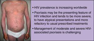 Psoriasis asociada al VIH.