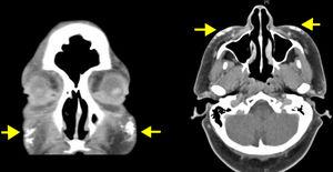 Imagen de TAC donde se observan lesiones hiperintensas con densidad calcio (flechas amarillas) sobre ambas regiones malares, en un corte coronal y transversal.