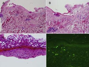 A) Ampolla subepidérmica con escaso infiltrado inflamatorio dérmico (H-E, ×4). B) Suelo dérmico con depósito fibrinoso sin apenas infiltrado inflamatorio asociado (H-E, ×10). C) Epidermis desprendida con desvitalización de la capa basal y queratinocitos necróticos (H-E, ×20). D) Estudio de inmunofluorescencia directa negativo.