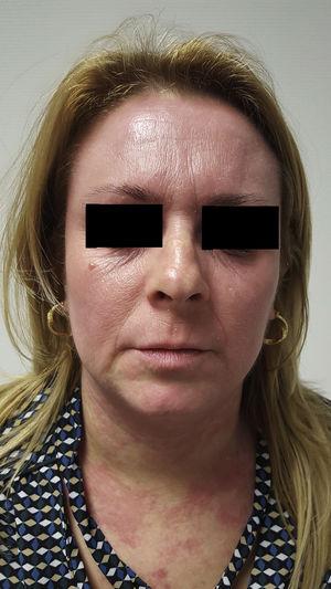 Eritema y edema en cara y cuello de nuestra paciente al inicio del tratamiento con itraconazol.