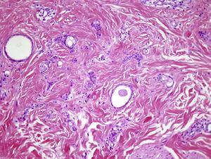 La biopsia mostraba en la dermis unas estructuras ductales recubiertas por un epitelio cuboideo con prolongaciones en forma de coma (hematoxilina-eosina x200).