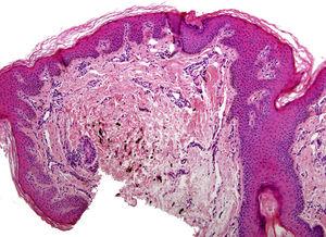 (H-E, 50x) Epidermis con acantosis y papilomatosis. A nivel de la dermis media, células fusiformes con pigmento melánico distribuidas entre los haces de colágeno.
