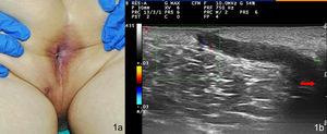 Imagen clínica y ecográfica del primer paciente. 1a: nódulo violáceo perineal izquierdo en el que se intuye el orificio central. 1b: banda hipoecoica correspondiente a tracto fistuloso que une la dermis inferior a la lesión con el canal anal (flecha roja).