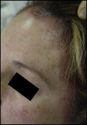 Eczema agudo en región frontal y línea de implantación capilar, tras aplicación de tinte.