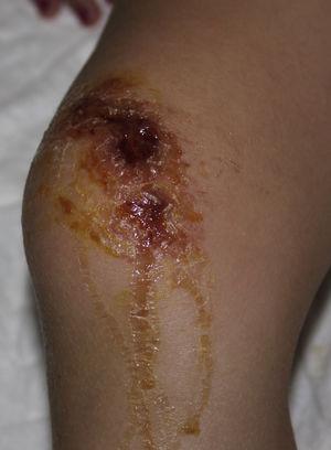 Lesiones vesiculosas exudativas en rodilla (caso 1).