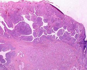 Tricoblastoma y siringocistoadenoma papilífero en el nevus sebáceo (numerosas estructuras parecidas a células germinales foliculares con invaginaciones císticas compuestas por 2 capas de células epiteliales) (H&E, ×10).