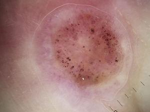 Imagen dermatoscópica donde destaca la presencia de numerosos puntos hemorrágicos sobre un área homogénea rosada.