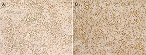 Las células tumorales, no solo la lesión escrotal primaria sino también la metástasis a los ganglios linfáticos, eran fuertemente inmunorreactivas para G-CSF (A) y el receptor de G-CSF (B) (×100).