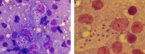 Estudio microscópico del frotis obtenido mediante el raspado del borde de la lesión del párpado. A) Macrófagos con amastigotes de Leishmania major (tinción de Riu, 400×). B) Mayor aumento (tinción de Riu 1.000×).